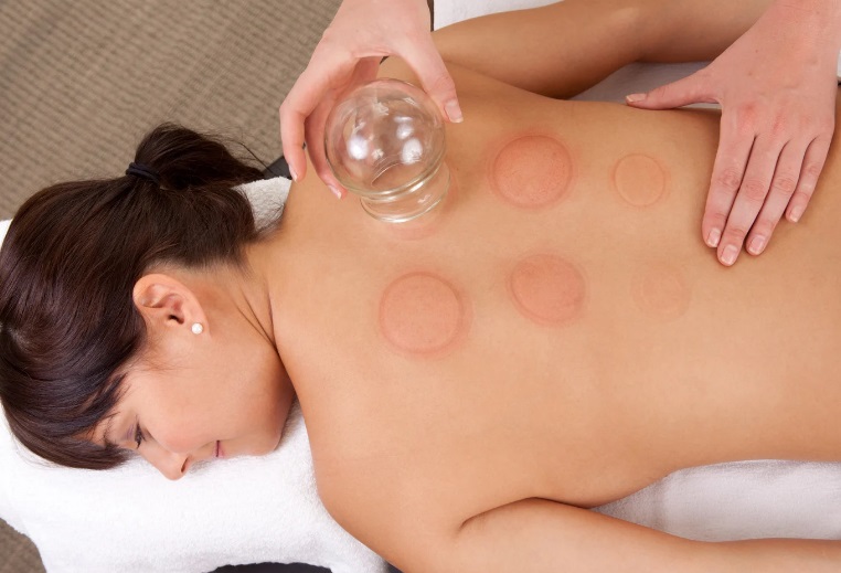 Cupping therapy Stirling